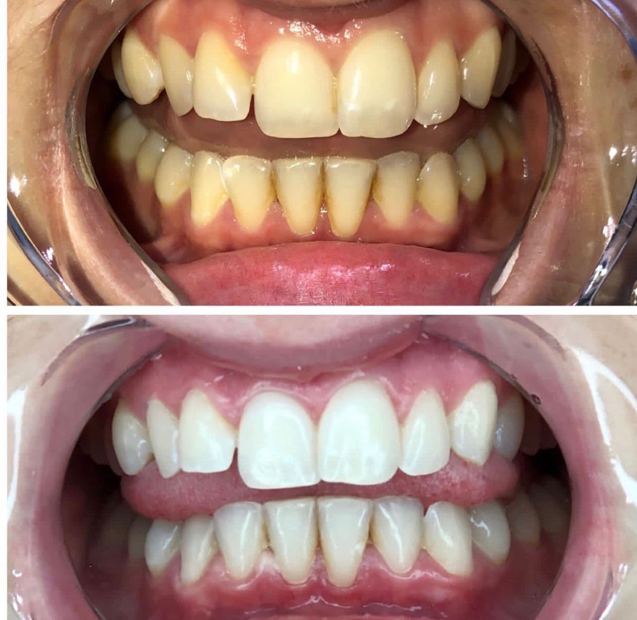 Teeth whitening before and after 3